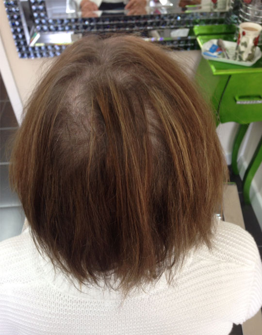 Hair InXs Womens Hair Loss Transformation Before