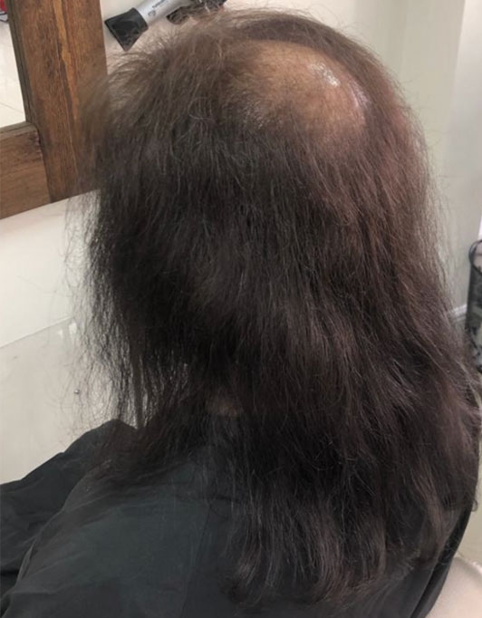 Hair InXs Womens Hair Loss Transformation Gallery Before