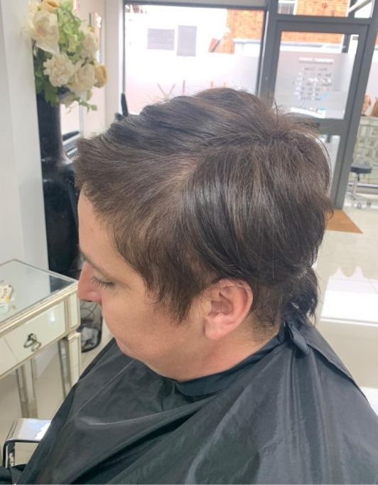 Hair InXs Womens Hair Loss Transformation Gallery Before