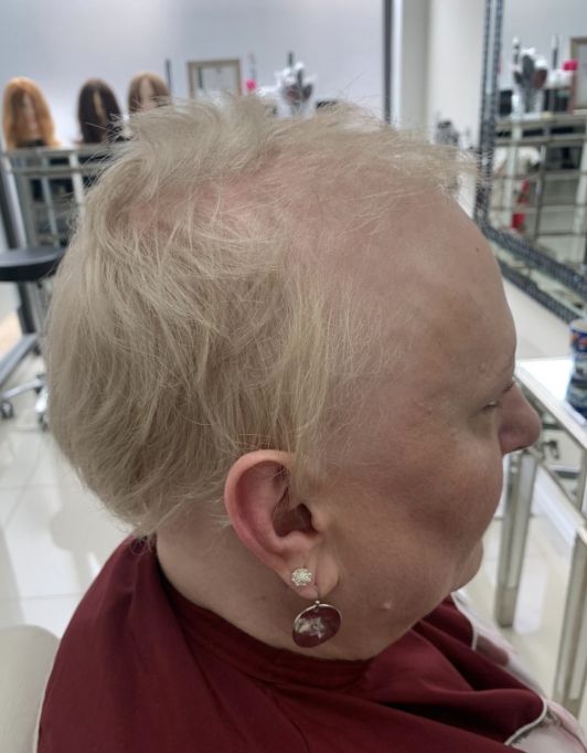 Hair InXs Womens Hair Loss Transformation Gallery Before