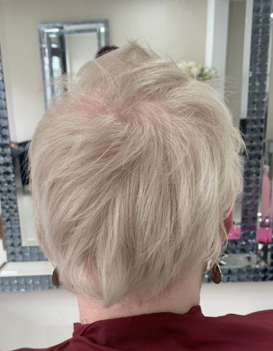 Hair InXs Womens Hair Loss Transformation Gallery Before