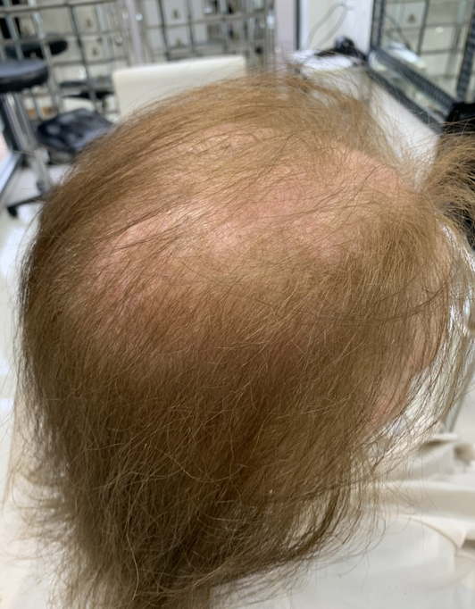 Hair InXs Womens Hair Loss Transformation Gallery Before