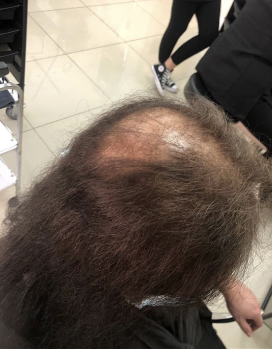 Hair InXs Womens Hair Loss Transformation Gallery Before