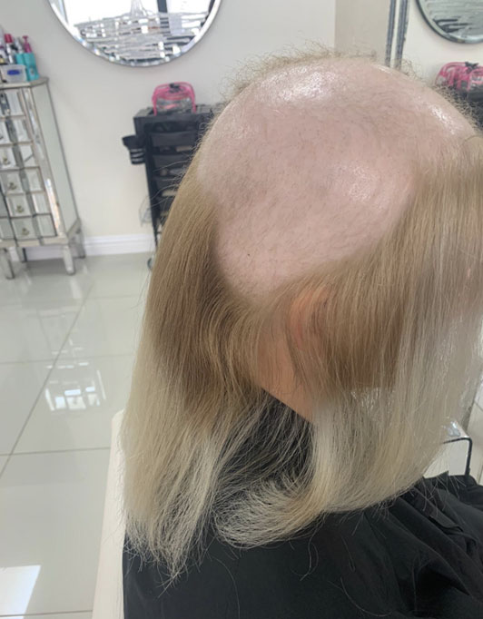 Hair InXs Womens Hair Loss Transformation Gallery Before