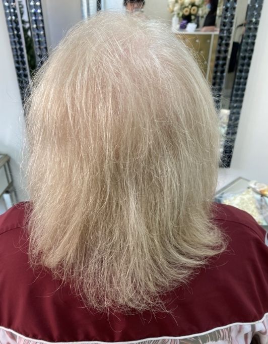 Hair InXs Womens Hair Loss Transformation Gallery Before