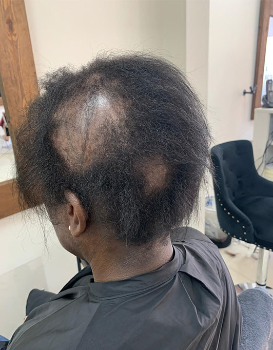 Hair InXs Womens Hair Loss Transformation Gallery Before