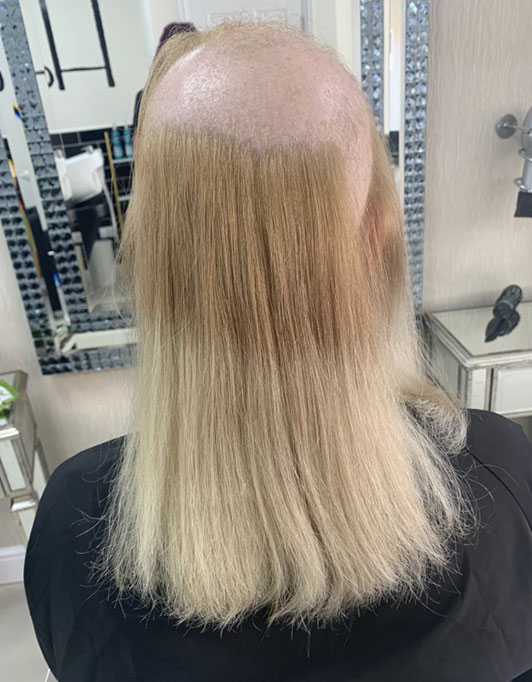 Hair InXs Womens Hair Loss Transformation Gallery Before