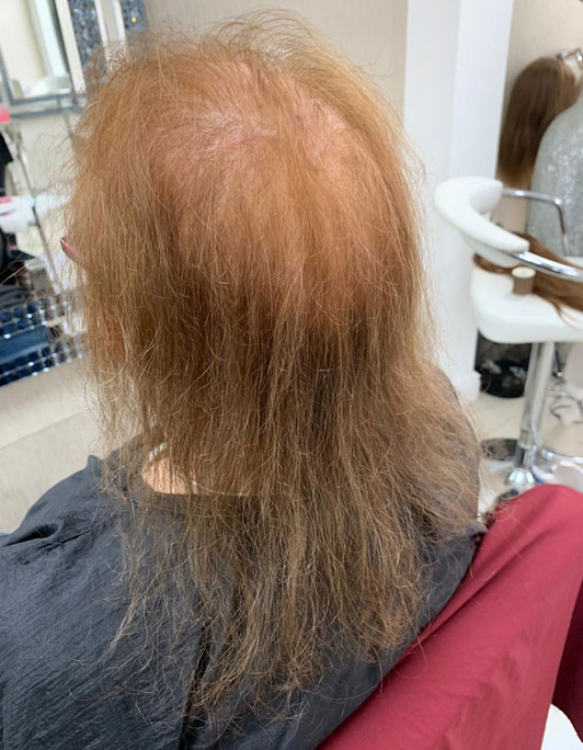Hair InXs Womens Hair Loss Transformation Gallery Before