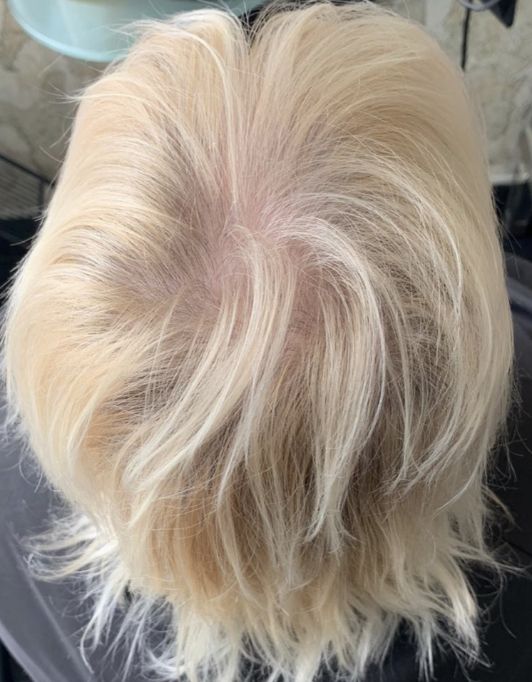 Hair InXs Womens Hair Loss Transformation Gallery Before