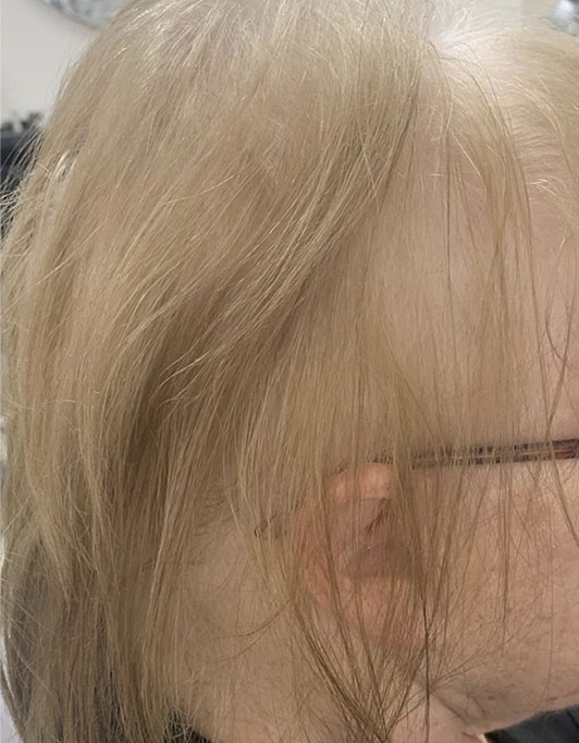 Hair InXs Womens Hair Loss Transformation Gallery Before