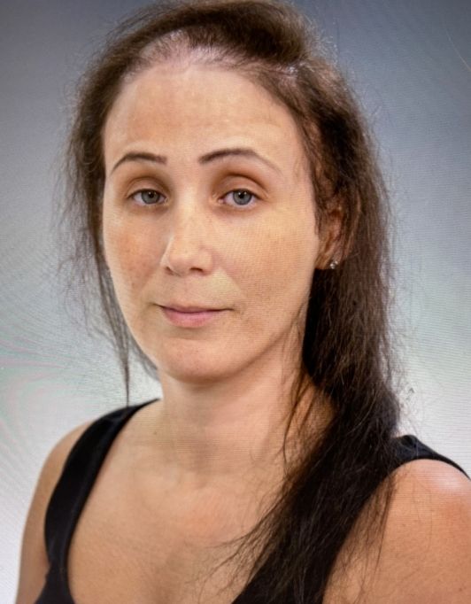 Hair InXs Womens Hair Loss Transformation Gallery Before
