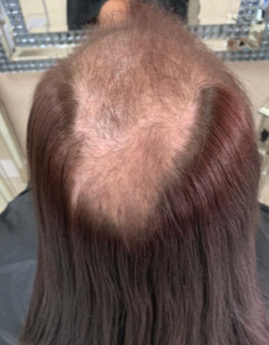 Hair InXs Womens Hair Loss Transformation Gallery Before