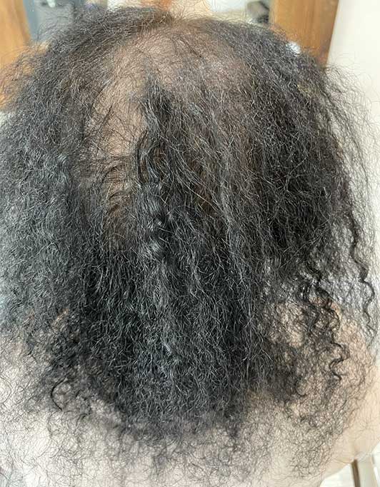 Hair InXs Womens Hair Loss Transformation Gallery Before