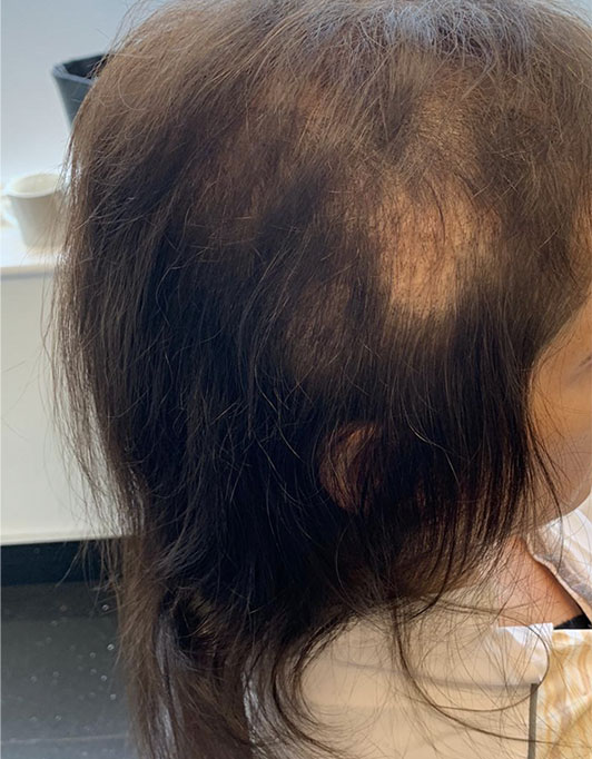 Hair InXs Womens Hair Loss Transformation Gallery Before