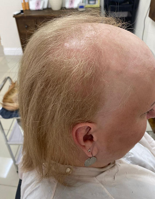 Hair InXs Womens Hair Loss Transformation Gallery Before