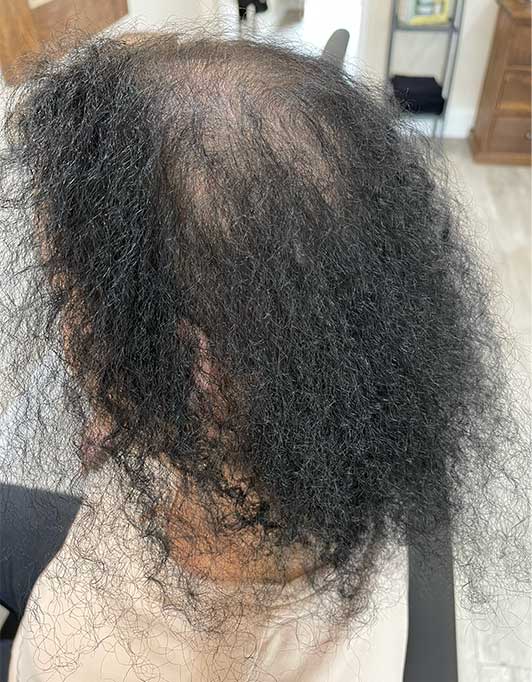 Hair InXs Womens Hair Loss Transformation Gallery Before