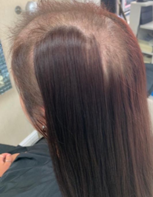 Hair InXs Womens Hair Loss Transformation Gallery Before