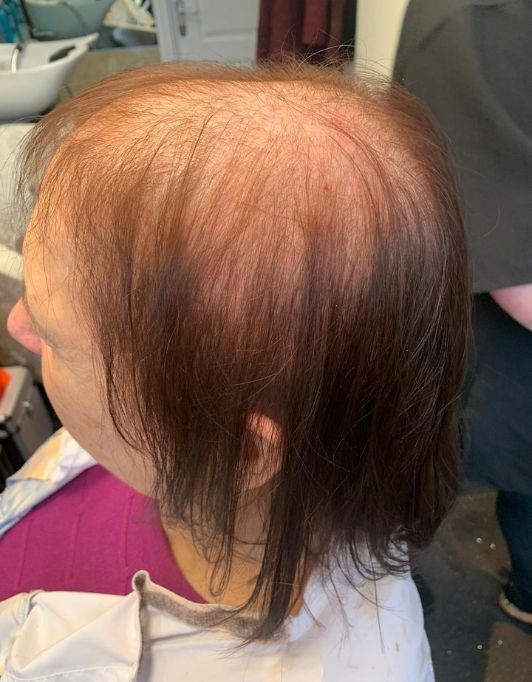 Hair InXs Womens Hair Loss Transformation Gallery Before