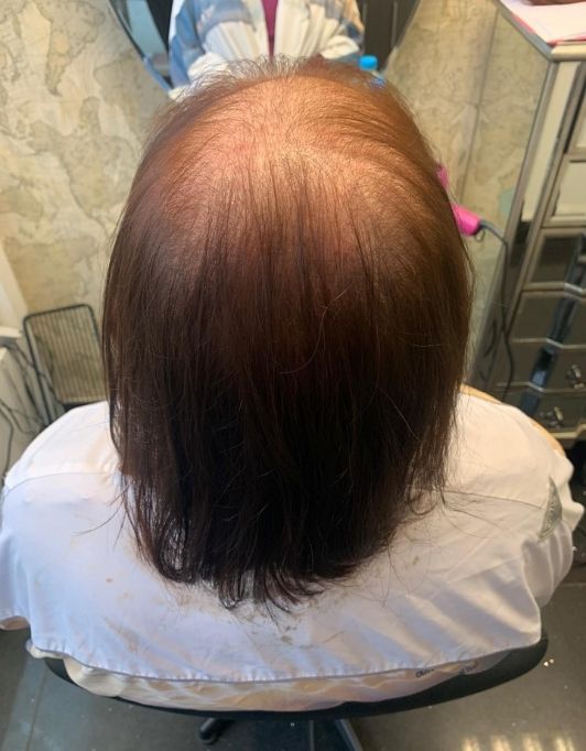 Hair InXs Womens Hair Loss Transformation Gallery Before