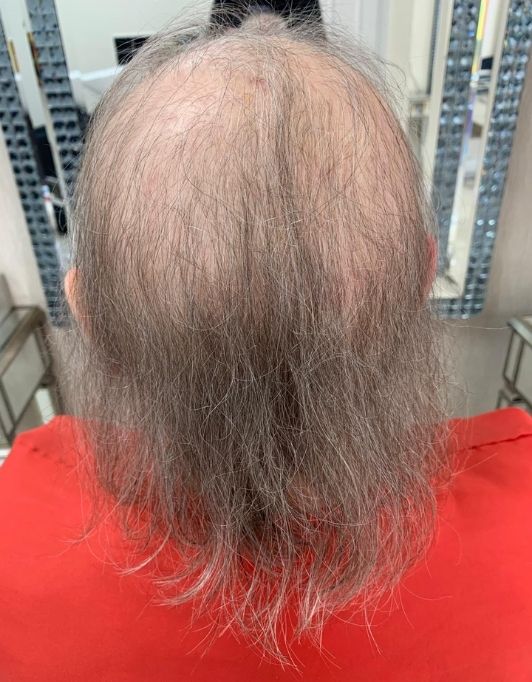 Hair InXs Womens Hair Loss Transformation Gallery Before