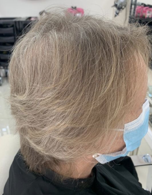 Hair InXs Womens Hair Loss Transformation Gallery Before