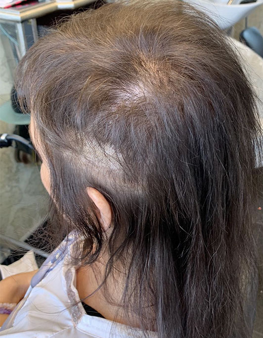 Hair InXs Womens Hair Loss Transformation Gallery Before