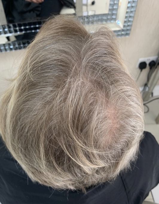 Hair InXs Womens Hair Loss Transformation Gallery Before