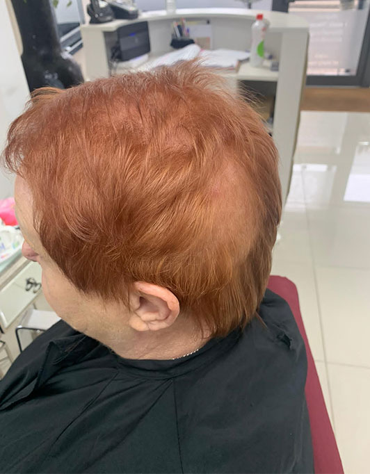 Hair InXs Womens Hair Loss Transformation Gallery Before