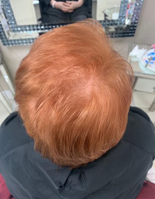 Hair InXs Womens Hair Loss Transformation Gallery Before