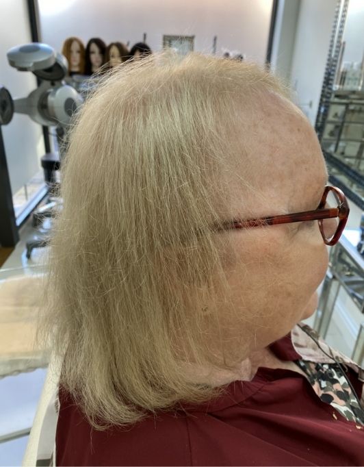 Hair InXs Womens Hair Loss Transformation Gallery Before