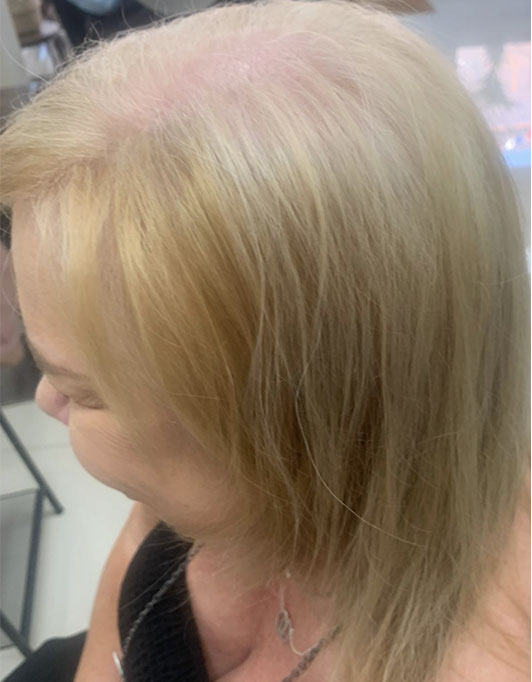 Hair InXs Womens Hair Loss Transformation Gallery Before
