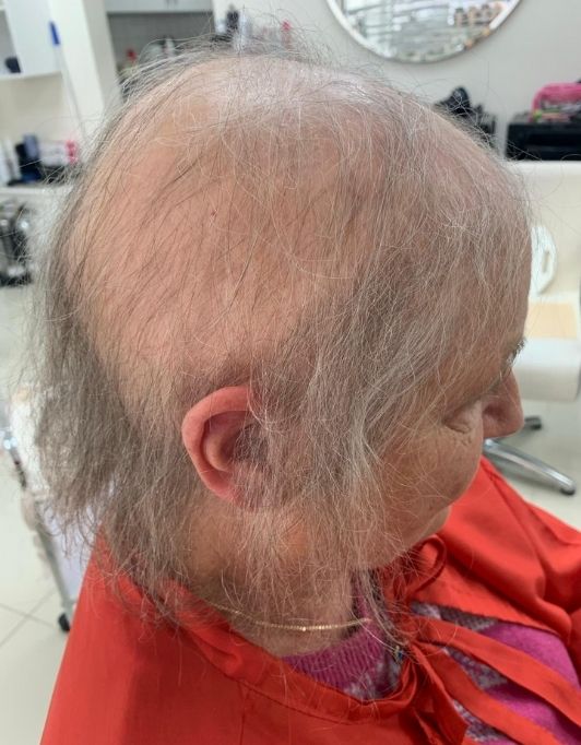 Hair InXs Womens Hair Loss Transformation Gallery Before