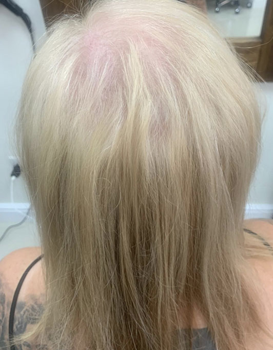 Hair InXs Womens Hair Loss Transformation Gallery Before