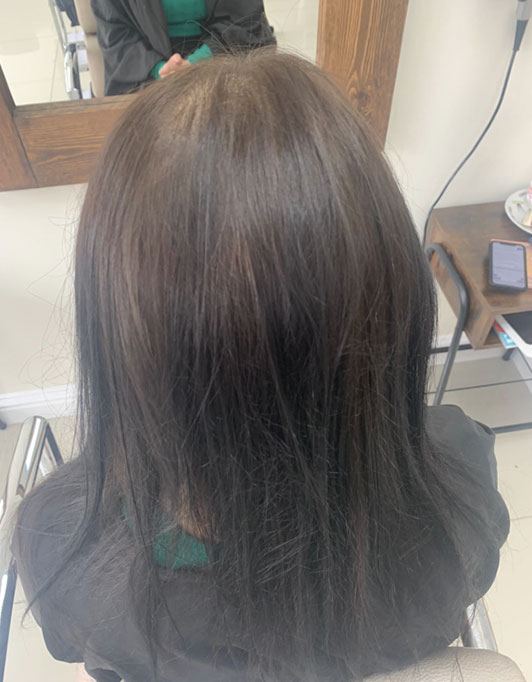 Hair InXs Womens Hair Loss Transformation Gallery Before