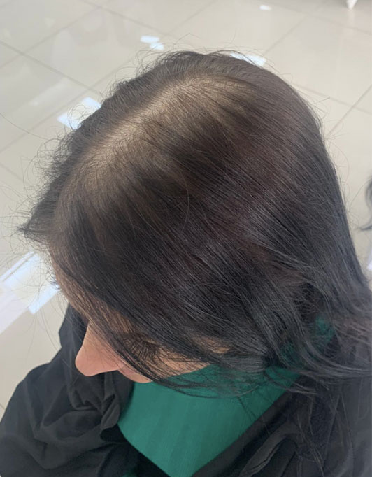 Hair InXs Womens Hair Loss Transformation Gallery Before