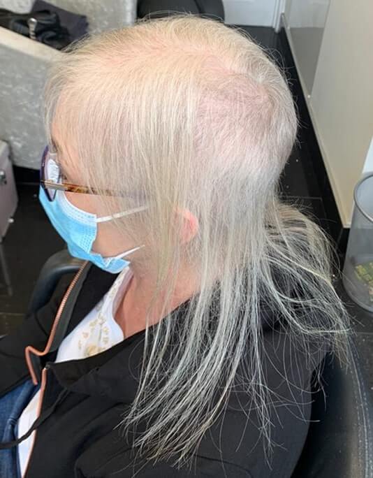 Hair InXs Womens Hair Loss Transformation Gallery Before