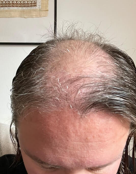Hair InXs Womens Hair Loss Transformation Gallery Before
