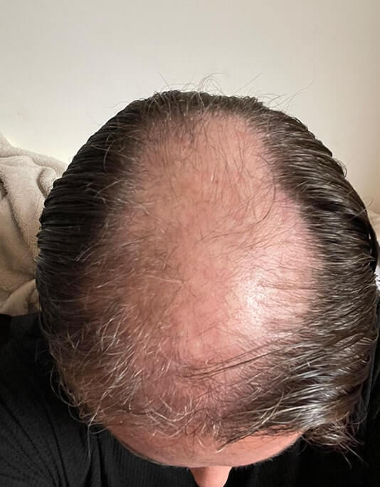 Hair InXs Womens Hair Loss Transformation Gallery Before