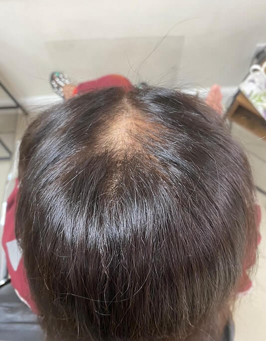 Hair InXs Womens Hair Loss Transformation Gallery Before