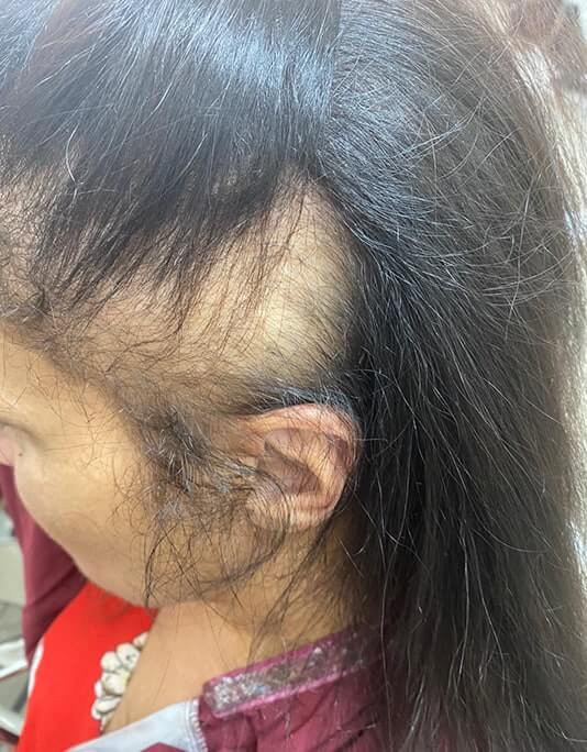 Hair InXs Womens Hair Loss Transformation Gallery Before
