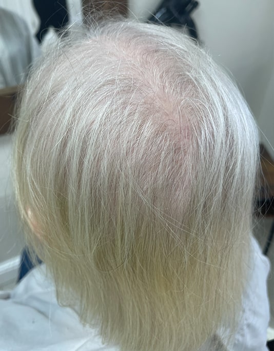 Hair InXs Womens Hair Loss Transformation Gallery Before