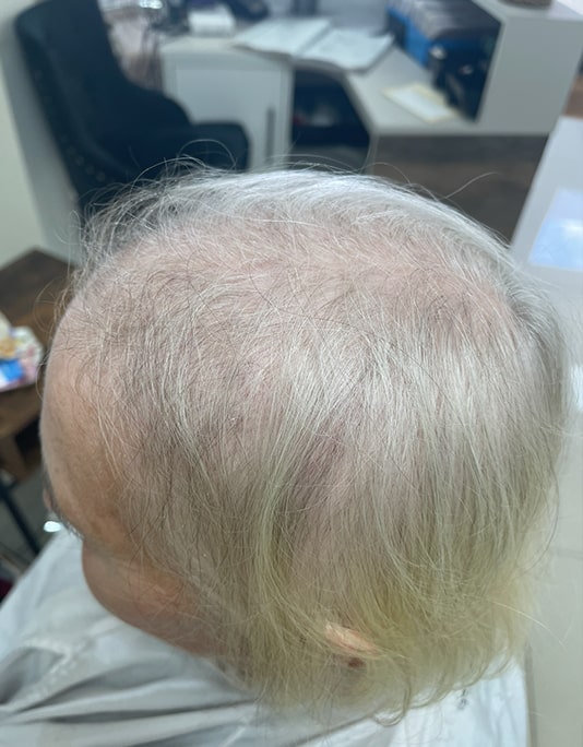 Hair InXs Womens Hair Loss Transformation Gallery Before
