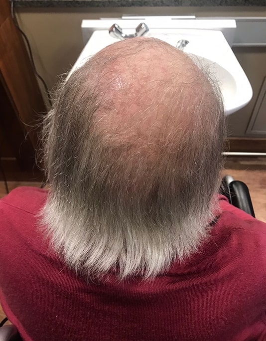 Hair InXs Womens Hair Loss Transformation Gallery Before