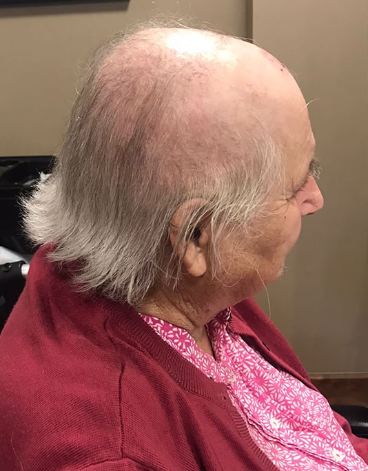 Hair InXs Womens Hair Loss Transformation Gallery Before