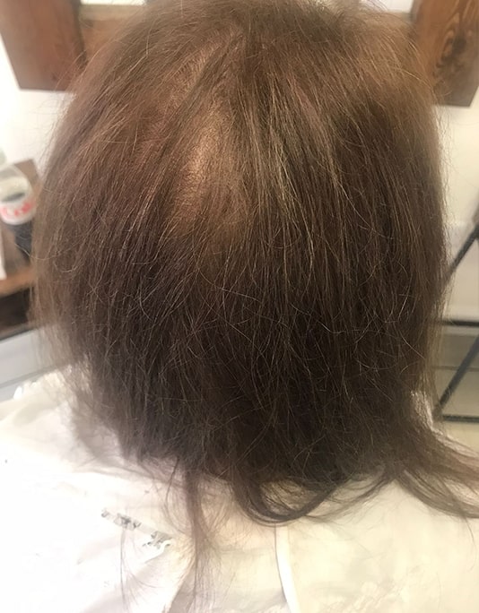 Hair InXs Womens Hair Loss Transformation Gallery Before
