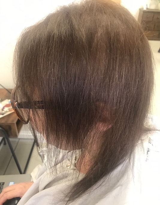 Hair InXs Womens Hair Loss Transformation Gallery Before