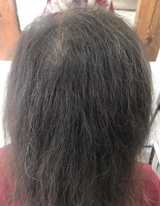 Hair InXs Womens Hair Loss Transformation Gallery Before