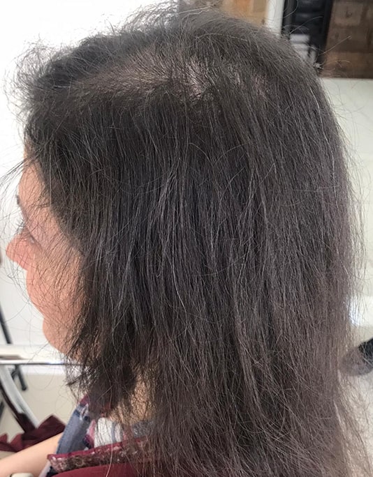 Hair InXs Womens Hair Loss Transformation Gallery Before