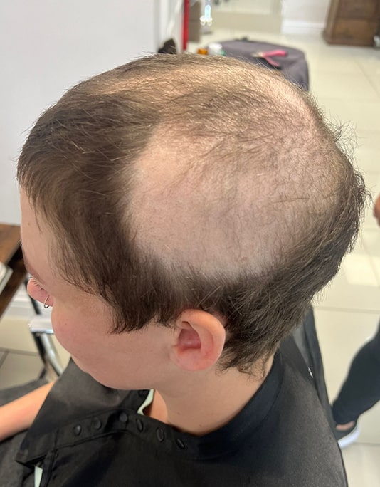 Hair InXs Womens Hair Loss Transformation Gallery Before