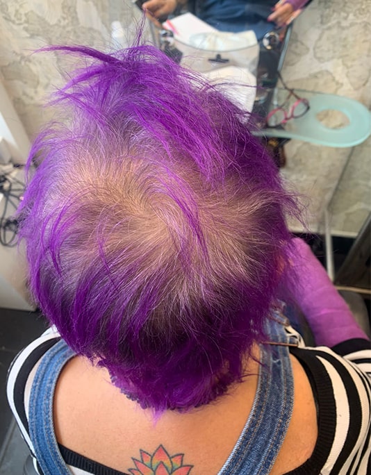 Hair InXs Womens Hair Loss Transformation Gallery Before